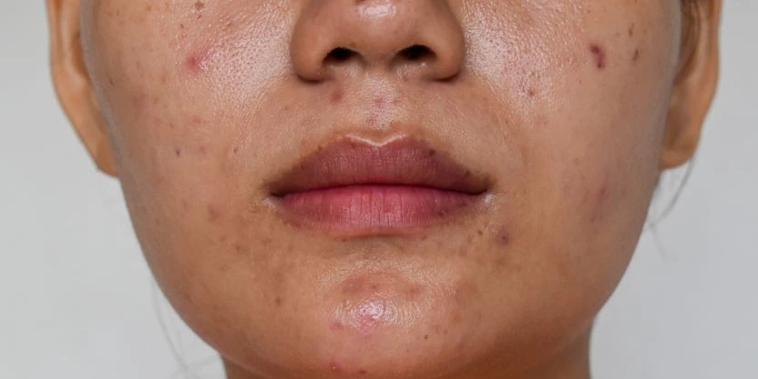 علاج التصبغات والبقع الداكنة في الوجه بطرق فعالة