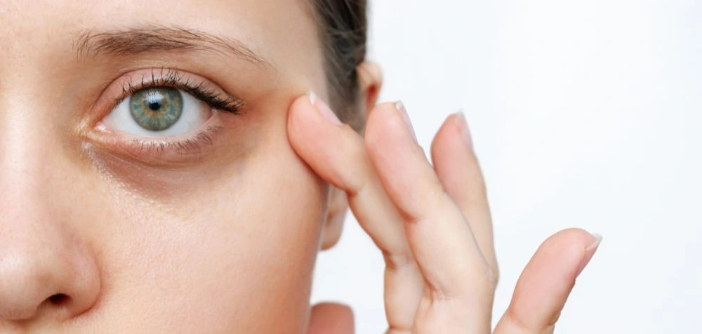 أفضل طرق علاج الهالات السوداء تحت العين طبيعياً